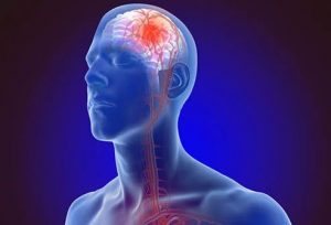 PHYSIOTHERAPY AFTER STROKE