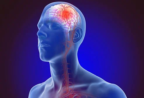 PHYSIOTHERAPY AFTER STROKE